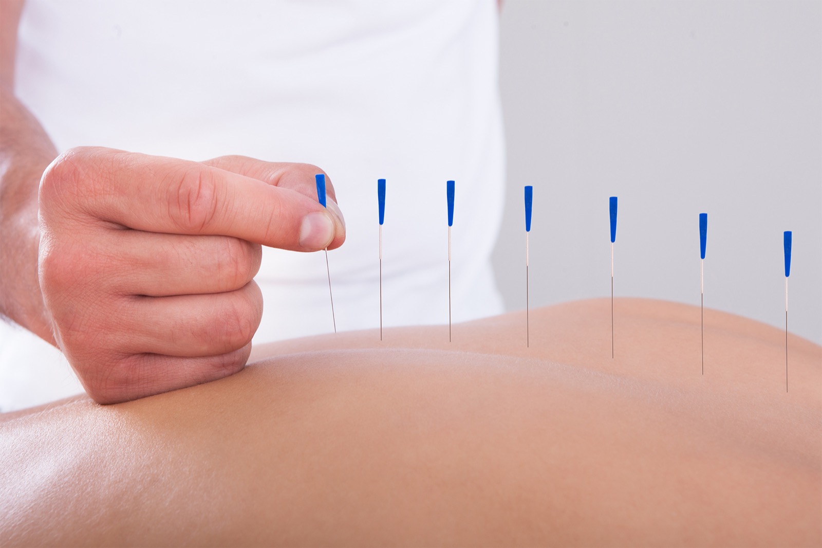 Is Acupuncture Actually Effective for Office Goers?