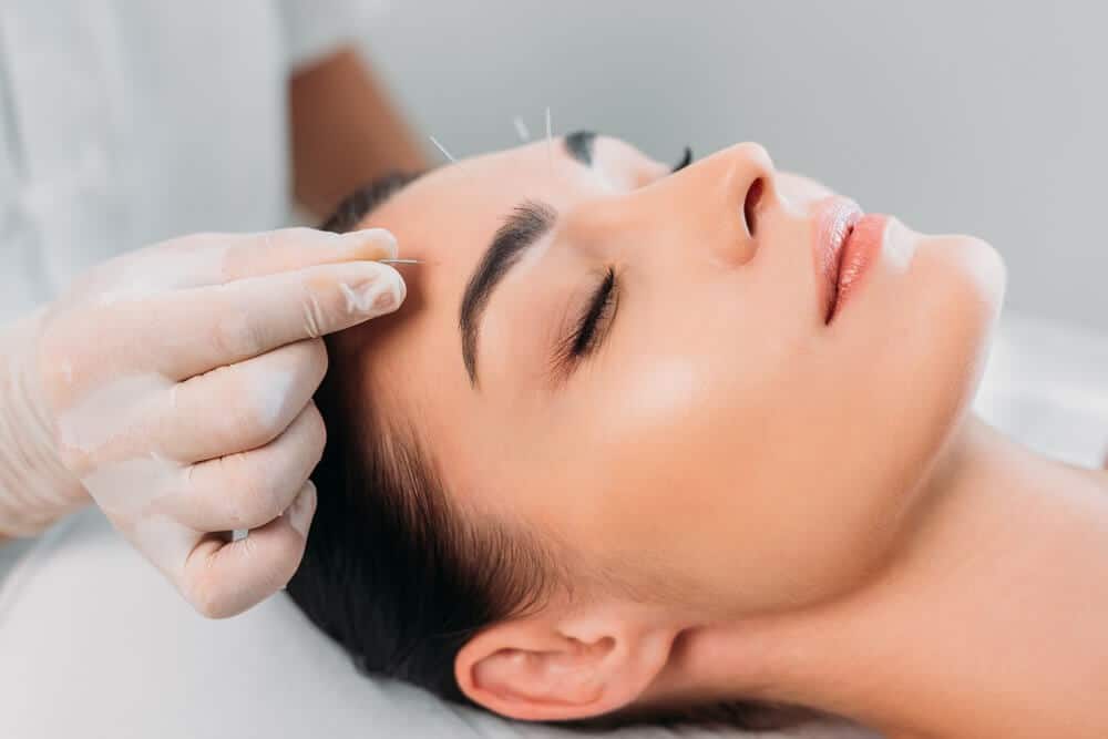 Facial Acupuncture