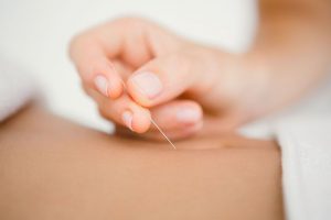 Dry Needling Technique Electrotherapy Bioelectrical Dysfunction Urgent Care Chiropractic